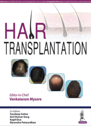 Hair Transplantation by Venkataram Mysore