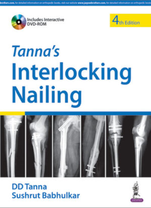 Tanna’s Interlocking Nailing by DD Tanna