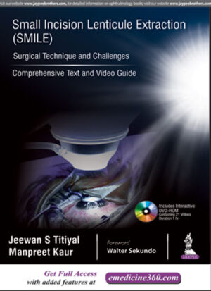 Small Incision Lenticule Extraction (SMILE): Surgical Technique and Challenges (Comprehensive Text and Video Guide) by Jeewan S Titiyal