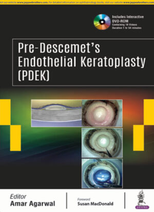 Pre-Descemet’s Endothelial Keratoplasty (PDEK) Includes Interactive DVD-ROM by Amar Agarwal