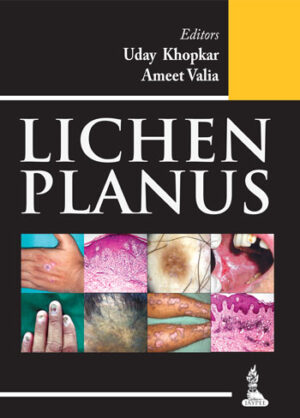 Lichen planus by Uday Khopkar, Ameet Valia