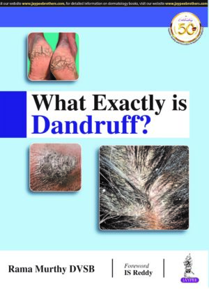What Exactly is Dandruff? by Rama Murthy DVSB