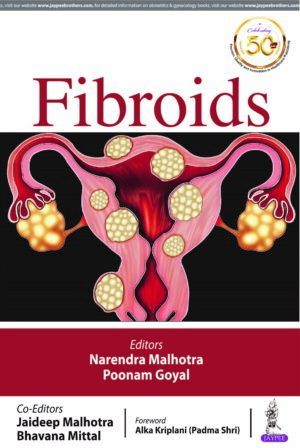 Fibroids by Narendra Malhotra