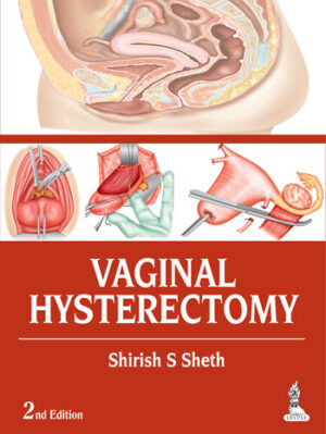 Vaginal Hysterectomy by Shirish S Sheth