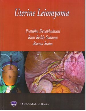 Uterine Leiomyoma by Pratibha Devabhaktuni