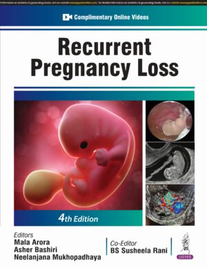 Recurrent Pregnancy Loss