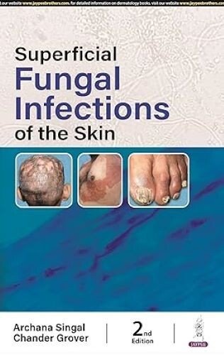 Superficial Fungal Infections of the Skin