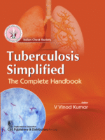 Tuberculosis Simplified The complete Handbook